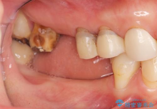 全顎 虫歯 インプラント治療の治療前