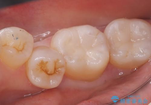 【セラミックインレー】口の中の銀の詰め物を白い物に替えたいの治療後