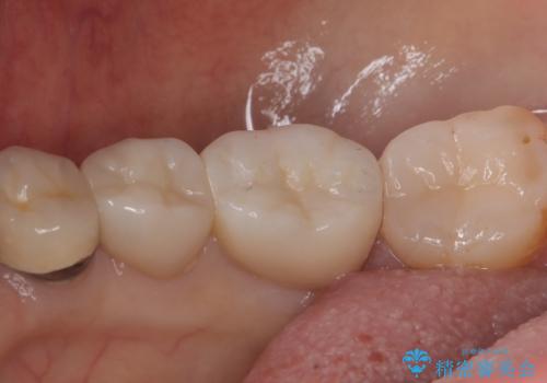 【セラミックインレー】笑うと銀の詰め物が目立つの治療後