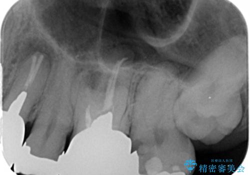銀歯・虫歯・治療途中の歯を治していきたいの治療前