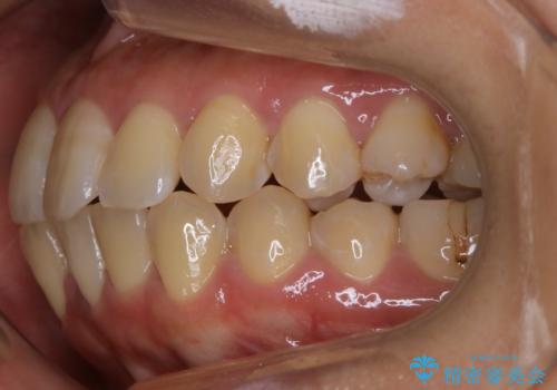 前歯を後ろに下げたい ワイヤー矯正(クリア装置)の治療前