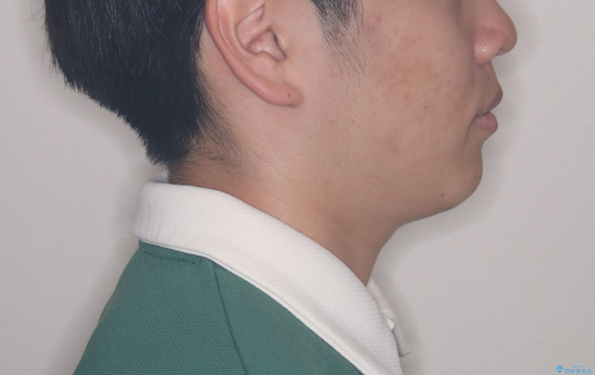 【ワイヤー矯正】前歯が出ているのが気になるの治療後(顔貌)