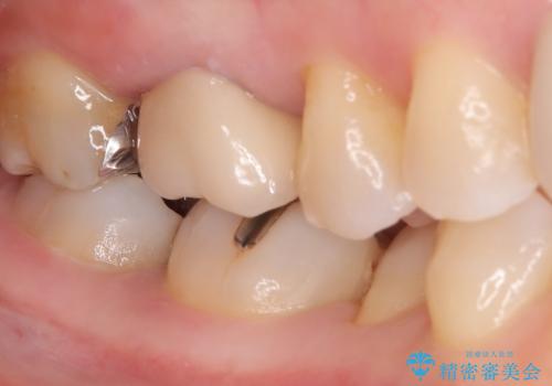 【セラミックインレー】口の中の銀の詰め物を白い物に替えたいの治療前