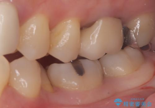 【セラミックインレー】口の中の銀の詰め物を白い物に替えたいの治療前