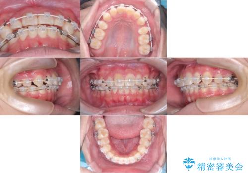 【ワイヤー矯正】前歯が出ているのが気になるの治療中