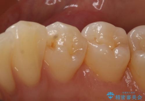 虫歯のところをセラミックで直したい セラミックインレーの治療前