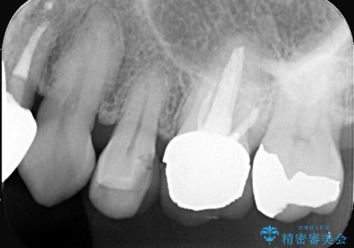 虫歯と古い被せ物をきれいに修復の治療前