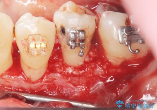 歯周病再生治療と歯周ポケット除去 歯周外科手術の治療前