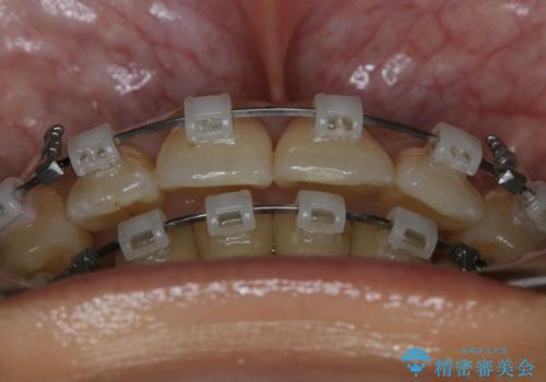 前歯を後ろに下げたい ワイヤー矯正(クリア装置)の治療中