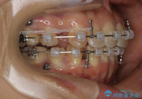 前歯を後ろに下げたい ワイヤー矯正(クリア装置)の治療中