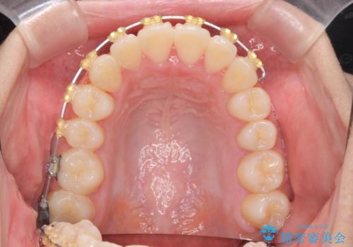 前歯のズレ・がたつき・すれ違いの矯正治療の治療中
