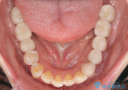 全顎 虫歯 インプラント治療の治療後
