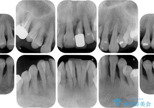 歯周病でグラグラの歯 矯正治療と歯周外科を併用した総合歯科治療の治療前