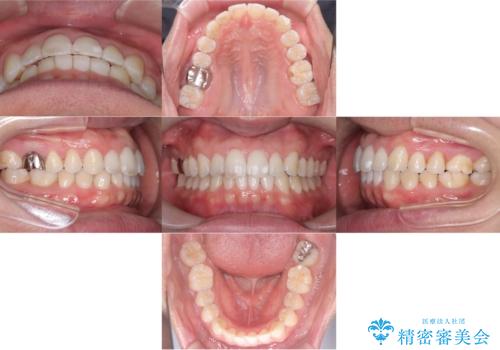 【マウスピース矯正】【インビザライン】前歯の凸凹を治したいの治療後