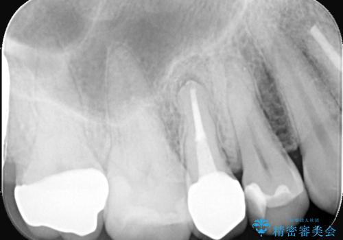 詰め物が欠けた 〈セラミッククラウン〉の治療後