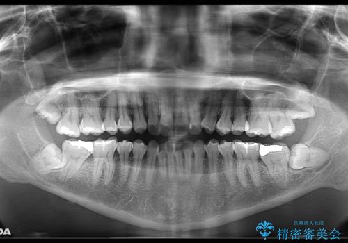 前歯を後ろに下げたい　ワイヤー矯正(クリア装置)の治療前