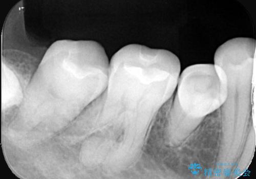【セラミックインレー】口の中の銀の詰め物を白い物に替えたいの治療後