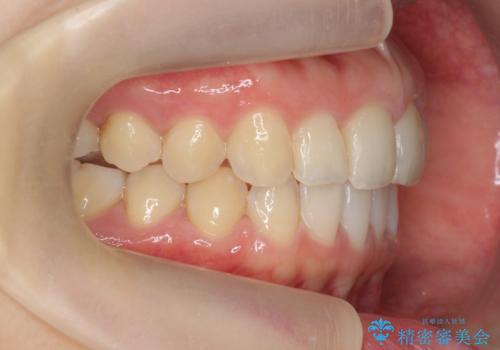 出っ歯に見える前歯の改善 部分ワイヤーとマウスピース矯正の治療後