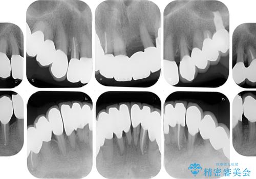 歯周病でグラグラの歯 矯正治療と歯周外科を併用した総合歯科治療の治療後