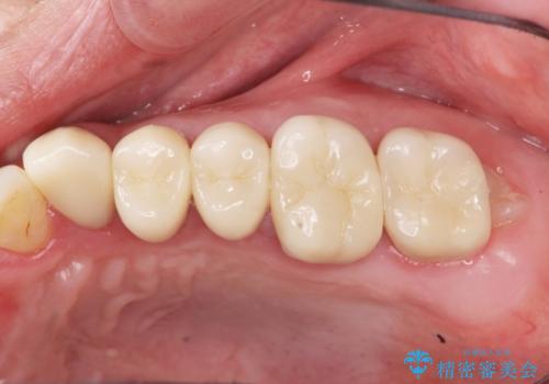 銀歯・虫歯・治療途中の歯を治していきたいの治療後