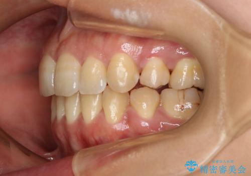 前歯を後ろに下げたい ワイヤー矯正(クリア装置)の治療後