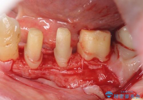 歯周病再生治療と歯周ポケット除去 歯周外科手術の治療中