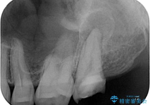 治療途中の虫歯の歯をインプラントにしたい インプラント治療の治療前