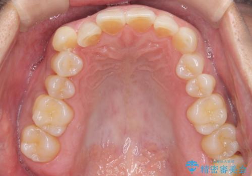 八重歯と下の歯のがたつき マウスピースでの治療前