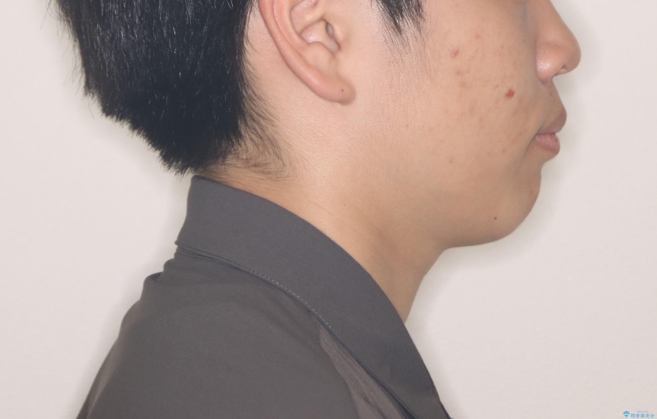 【ワイヤー矯正】前歯が出ているのが気になるの治療前(顔貌)