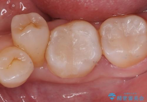 【セラミックインレー】口の中の銀の詰め物を白い物に替えたいの治療後