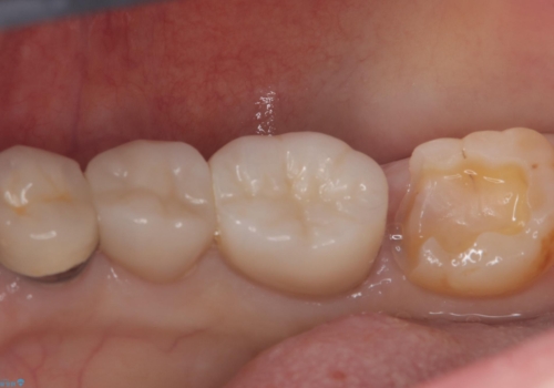 【セラミックインレー】笑うと銀の詰め物が目立つの治療中