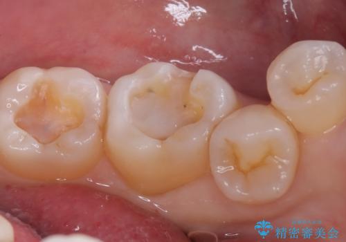 【セラミックインレー】口の中の銀の詰め物を白い物に替えたいの治療中