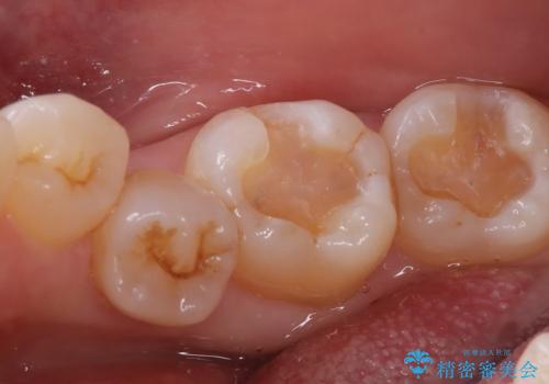 【セラミックインレー】口の中の銀の詰め物を白い物に替えたいの治療中