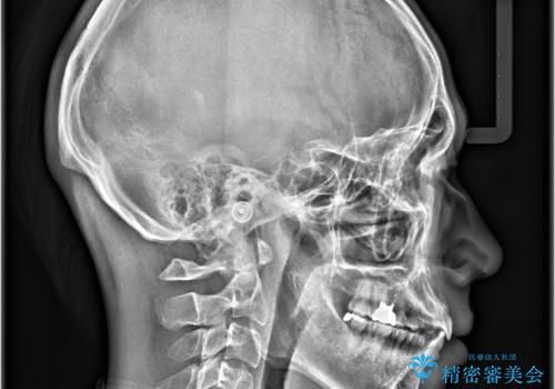 【マウスピース矯正】【インビザライン】前歯の凸凹を治したいの治療後
