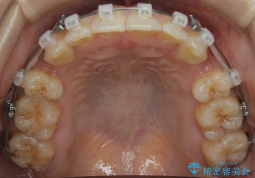 前歯を後ろに下げたい ワイヤー矯正(クリア装置)の治療中
