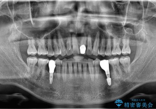 20年前にいれたインプラント|インプラント周囲炎|古いインプラントを除去しインプラント再埋入|痛く無いインプラント治療の治療後
