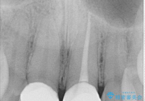 前歯の根のところに違和感がある|根尖性歯周炎|精密根管治療|オールセラミッククラウン|見た目も改善の治療後