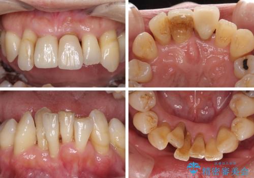 歯周病でグラグラの歯 矯正治療と歯周外科を併用した総合歯科治療の治療前