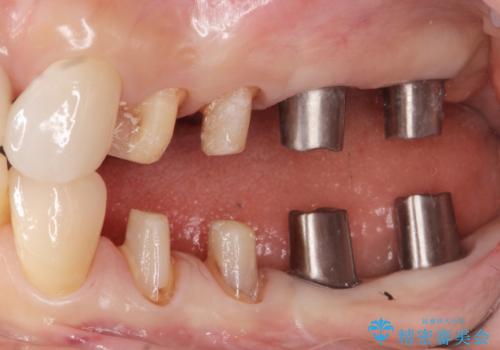 全顎 虫歯 インプラント治療の治療中