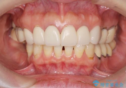 全顎 虫歯 インプラント治療の症例 治療前