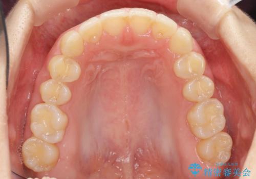 出っ歯に見える前歯の改善 部分ワイヤーとマウスピース矯正の治療後