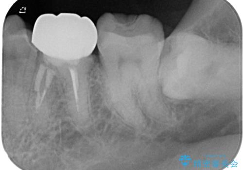 詰め物が欠けた フルジルコニアクラウンの治療前