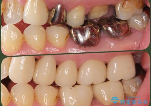 銀歯・虫歯・治療途中の歯を治していきたい