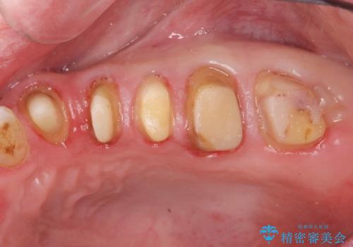 銀歯・虫歯・治療途中の歯を治していきたいの治療中
