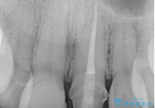 前歯の根のところに違和感がある|根尖性歯周炎|精密根管治療|オールセラミッククラウン|見た目も改善の治療中