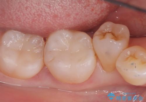 【セラミックインレー】口の中の銀の詰め物を白い物に替えたいの治療後
