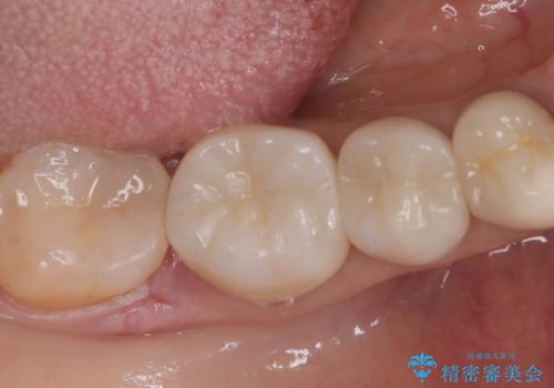 【セラミックインレー】笑うと銀の詰め物が目立つの治療後