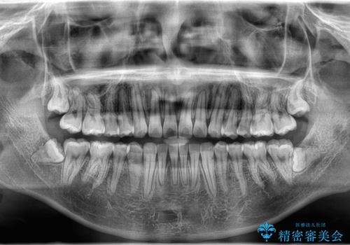 歯のデコボコを治したい|インビザラインで綺麗な歯並びに!|矯正期間は6ヵ月!の治療後