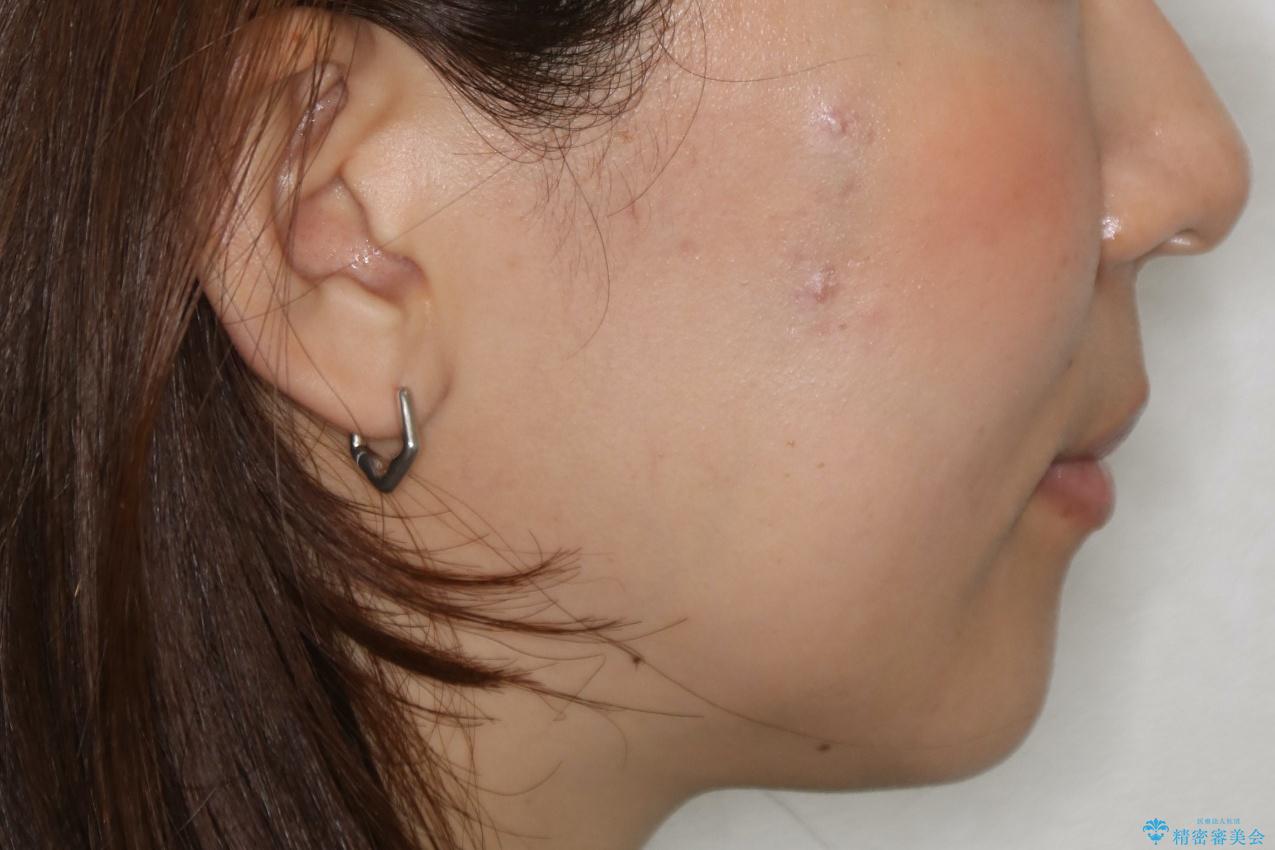 前歯を後ろに下げたい ワイヤー矯正(クリア装置)の治療後(顔貌)