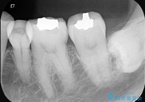 【セラミックインレー】口の中の銀の詰め物を白い物に替えたいの治療前